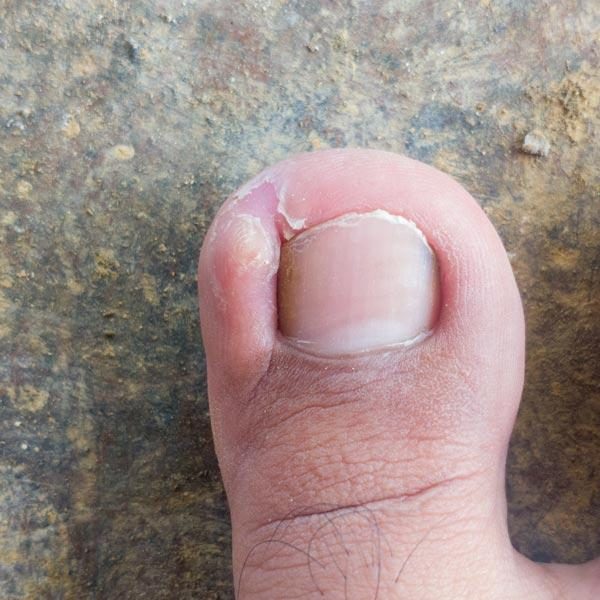 Podiatry toe